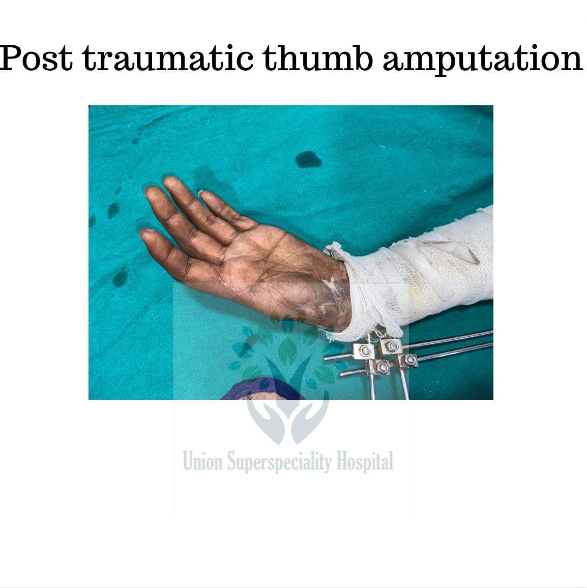 post hand injury
